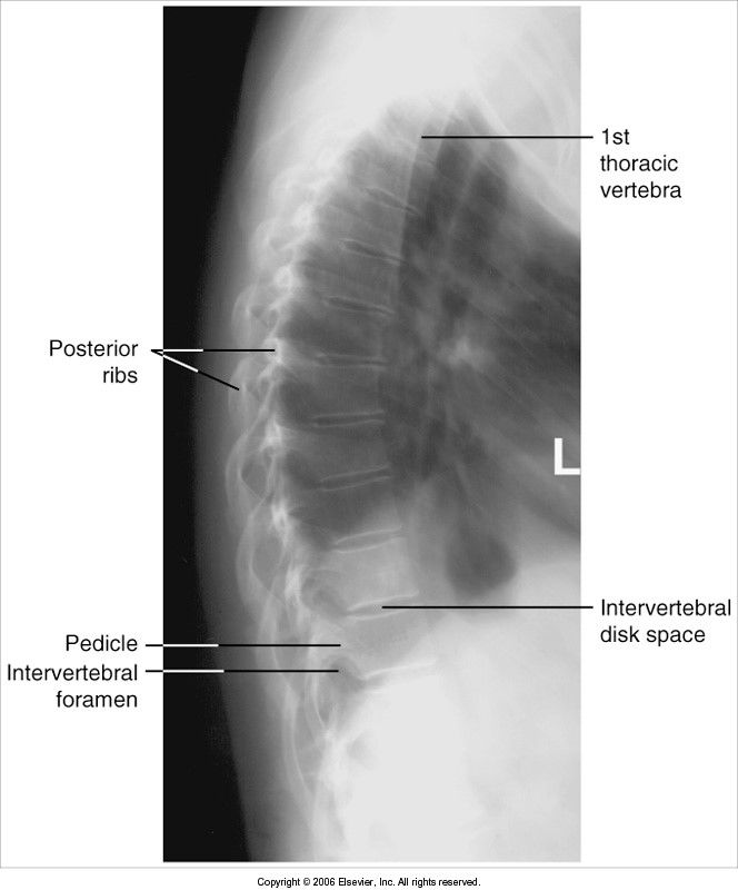 Lateral T-Spine Evaluation Criteria