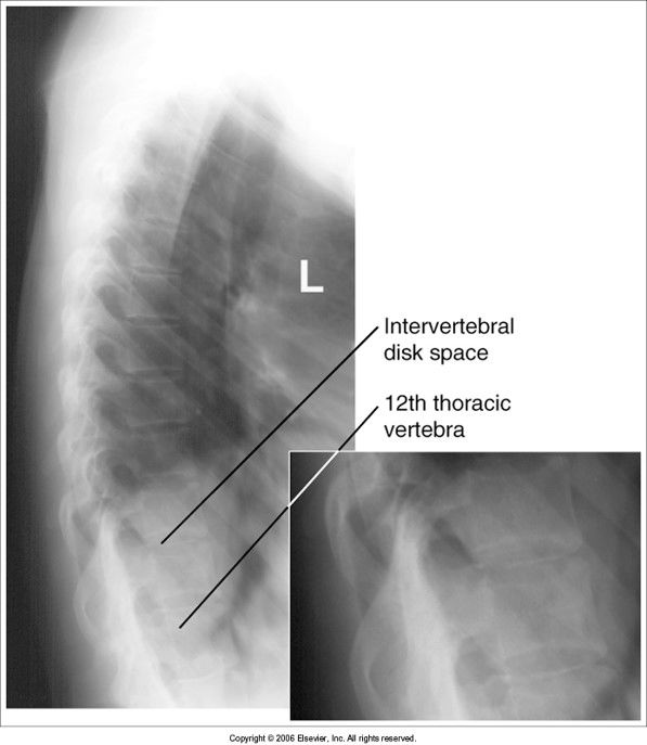 ribs are not blurred out: inadequate breathing technique lower thoracic vertebral bodies are obscured: pt's hips were not supported so sp...