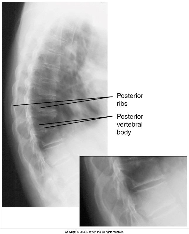 posterior ribs and vertebral bodies aren't superimposed: pt rotated