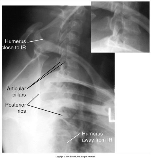 posterior ribs and vertebral bodies aren't superimposed: patient is rotated