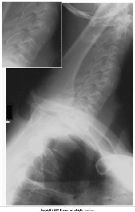 intervertebral disk spaces closed: c-spine is not parallel to IR