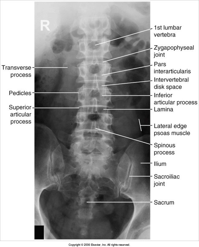 AP Lumbar evaluation criteria