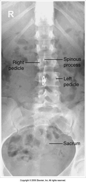 spinous processes are shifted to the right of the midline and the sacrum/coccyx shifted to the right of MSP: patient's hips rotated towar...