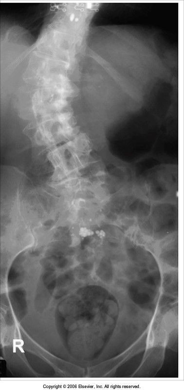 extreme scoliosis