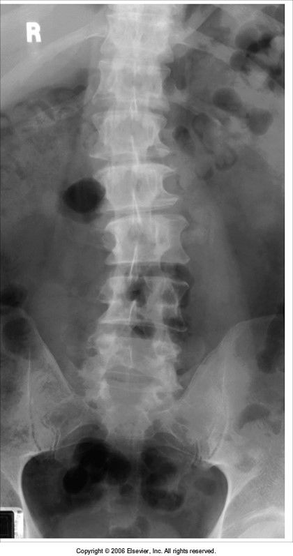 extreme scoliosis