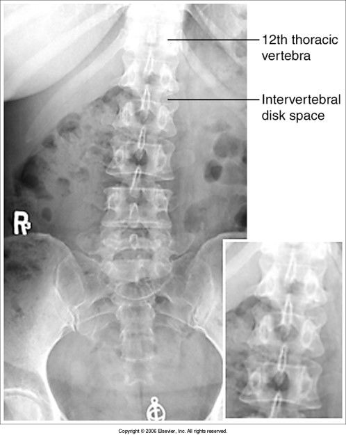 intervertebral disk spaces are closed: the knees and hips need to be flexed