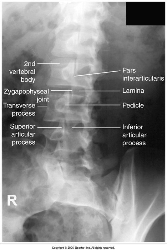 Oblique Lumbar evaluation criteria