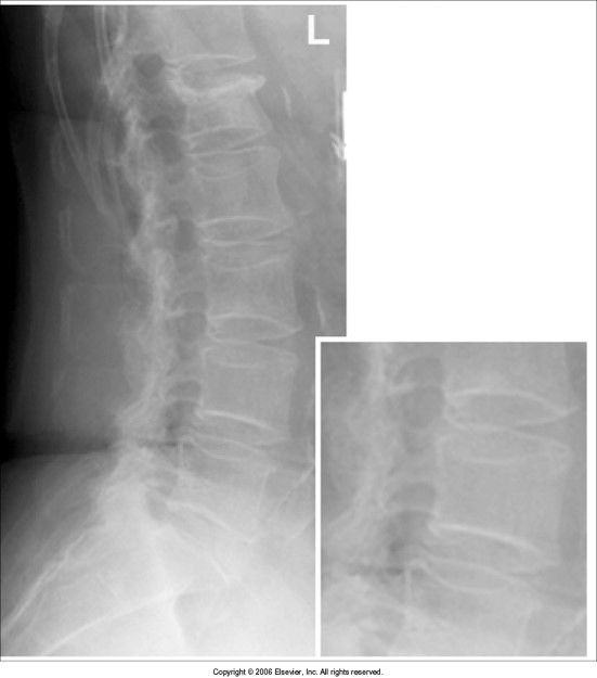 intervertebral disk spaces closed - hips/waist was not supported