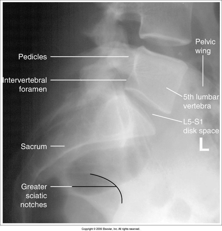 L5-S1 spot evaluation criteria