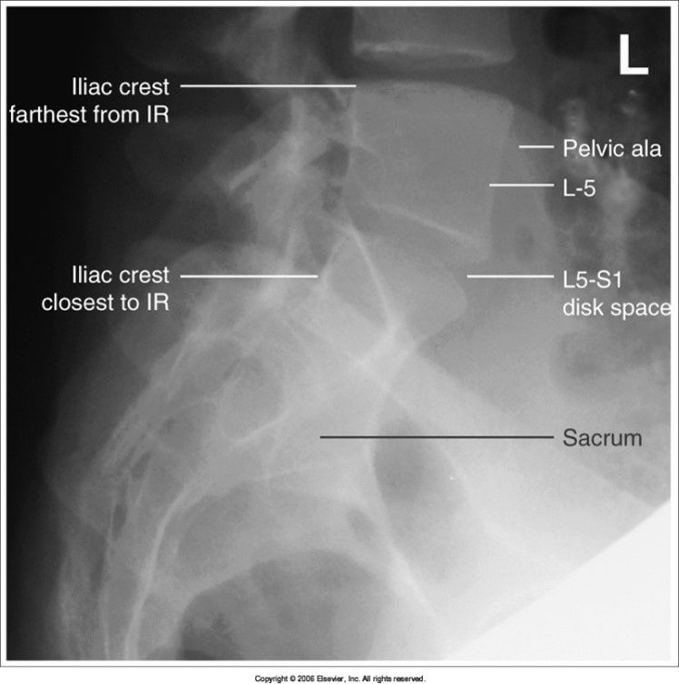 iliac wings are not superimposed - pelvis is tilted from being unsupported