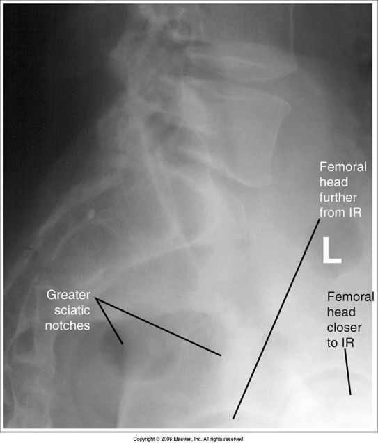 femoral heads aren't superimposed: pelvis is rotated