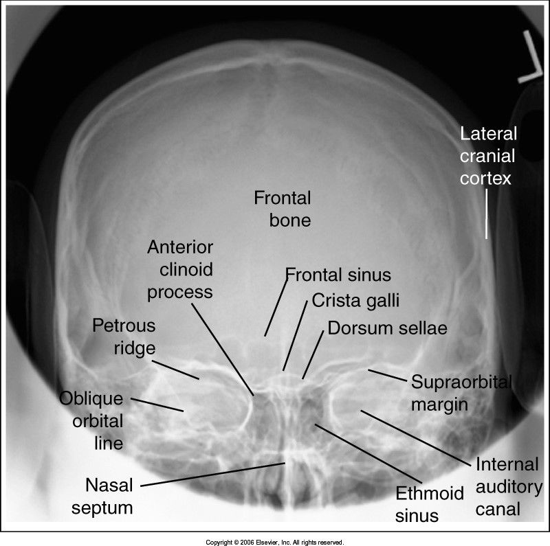 PA Skull 0 degrees evaluation criteria