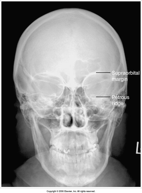 petrous ridges aren't filling the orbits chin isn't tucked enough to get OML perpendicular to IR