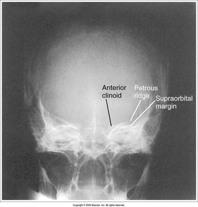 petrous ridges are seen above the orbital rims chin is tucked too much - OML isn't perpendicular