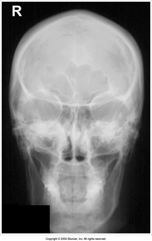 CR angle was 15 cephalic: orbits are magnified, skull is foreshortened *in trauma cases this is acceptable*