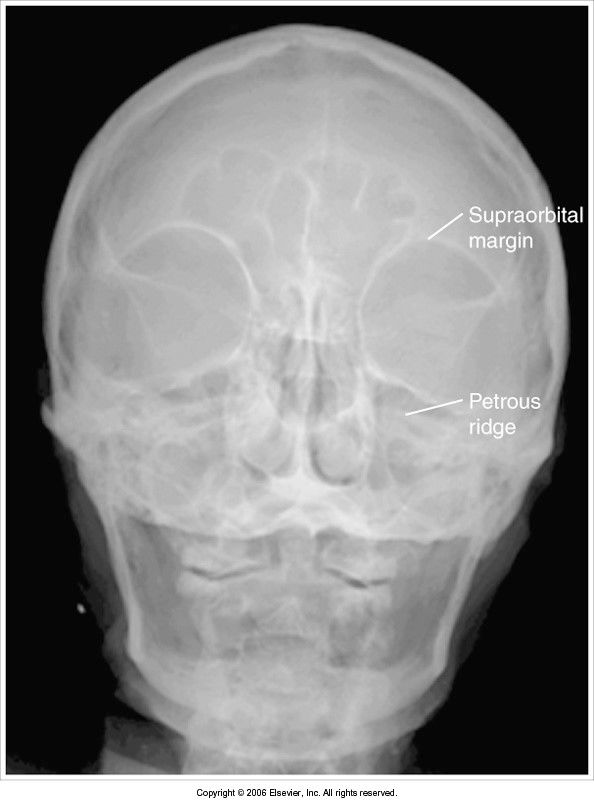 head is tilted petrous ridges are below orbital floors: CR was angled too caudal