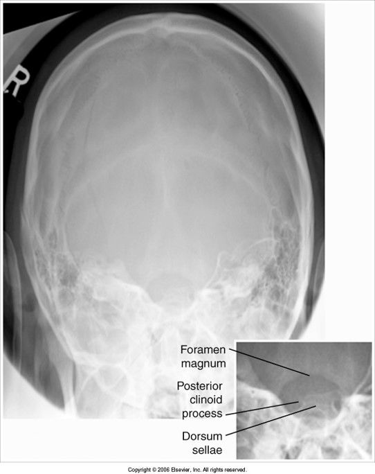 dorsum sellae is off center to the right: patient's face is turned to the left