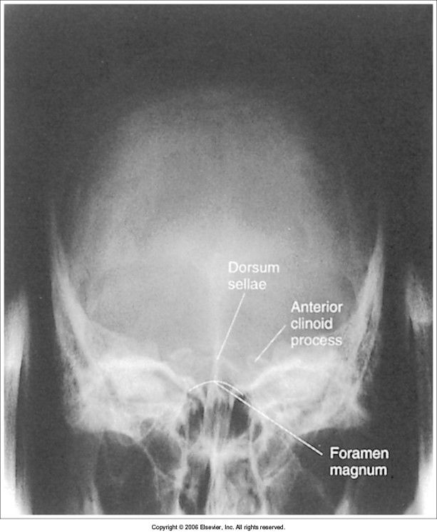 dorsum sellae is not within foramen magnum head is not flexed enough OR we need more tube angle