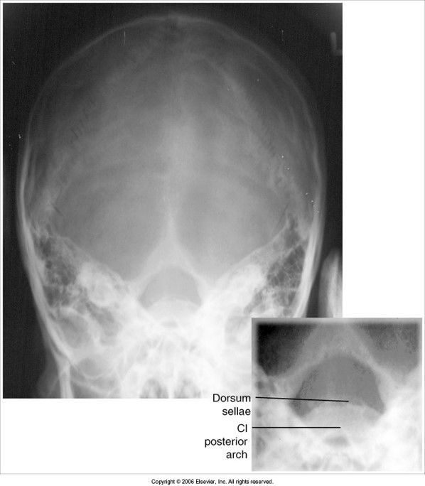 posterior arch of C1 is seen within foramen magnum: head is over flexed, OR the tube angle is too caudal