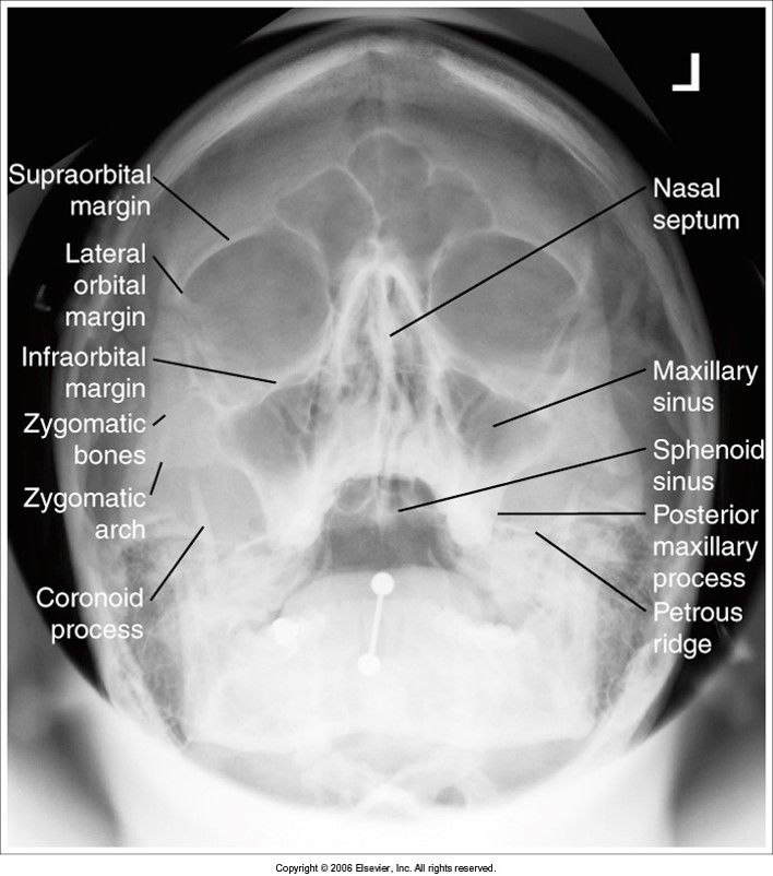 Parietoacanthial Waters Modified and Transoral evaluation criteria