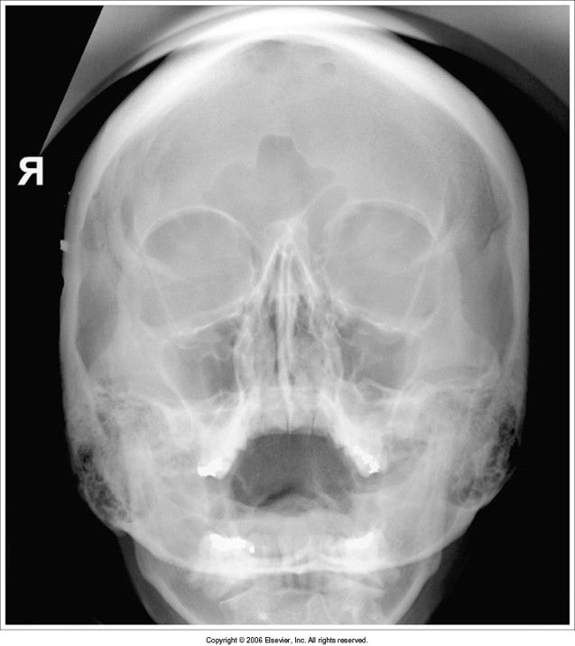 since this is a modified waters view, it's okay that the petrous ridges are within the maxillary sinuses *acceptable image*