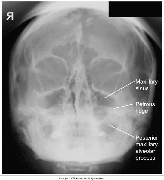 standard PA waters: -petrous ridges are within the maxillary sinuses: MML is not perpendicular to IR -head must be extended backward