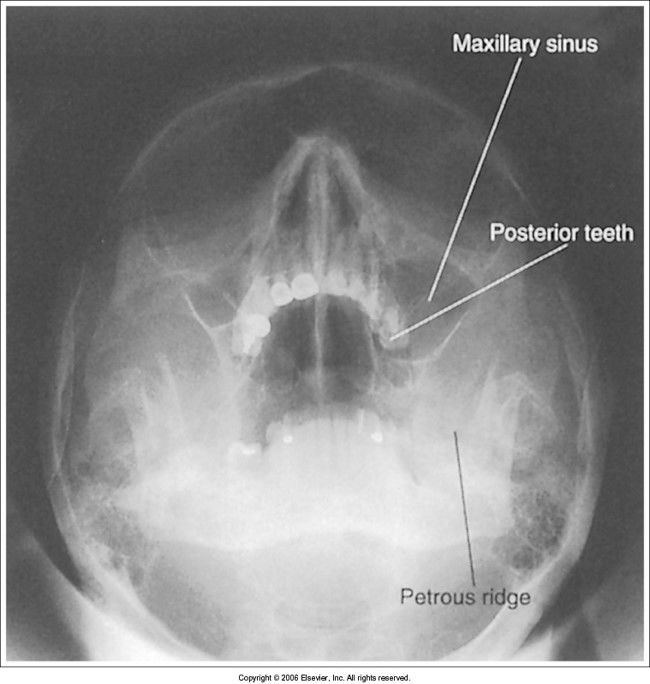 transoral waters: petrous ridges are low, and upper teeth are in maxillary sinuses head is overextended - flex head forward to bring MML ...