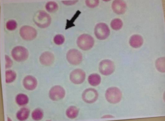 spherocyte