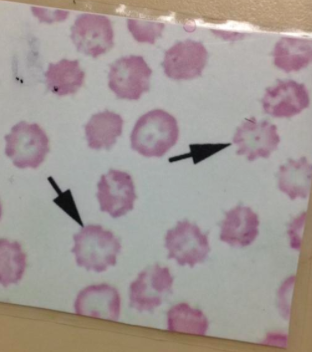 crenated RBC