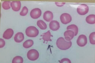 acanthocyte