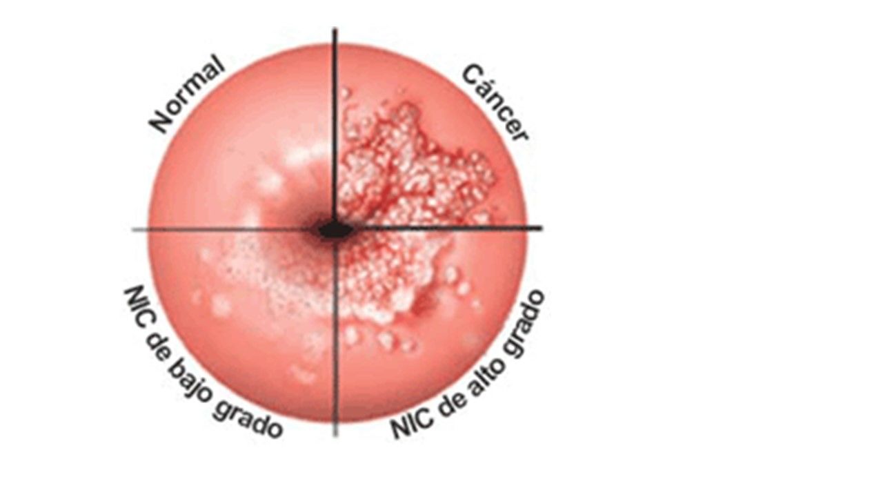 Sesión 36: Enfermedades Intraepitelial de cérvix, vagina y vulva