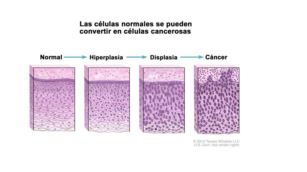 Sesión 36: Enfermedades Intraepitelial de cérvix, vagina y vulva