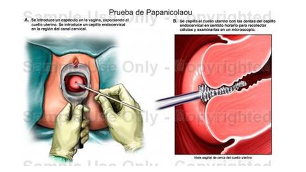 Sesión 36: Enfermedades Intraepitelial de cérvix, vagina y vulva