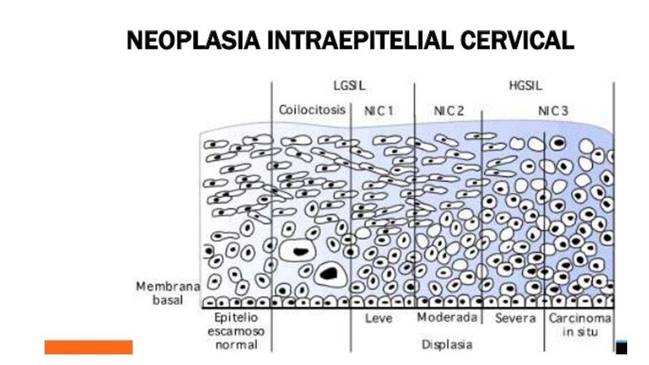 Sesión 36: Enfermedades Intraepitelial de cérvix, vagina y vulva