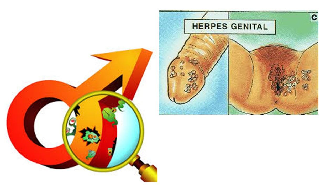 Sesión 29: Infecciones y Enfermedades de transmisión sexual