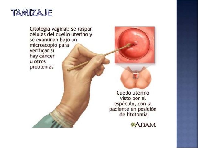 CÁNCER INVASOR DE CÉRVIX Y VAGINA