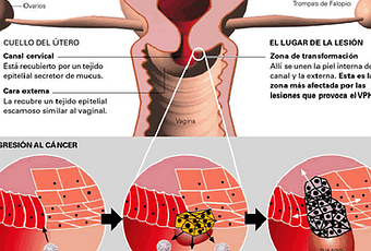 ENFERMEDAD INTRAEPITELIAL DE CERVIX, VAGINA Y VULVA