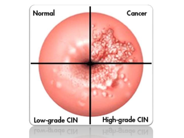 CÁNCER INVASOR DE CÉRVIX Y VAGINA