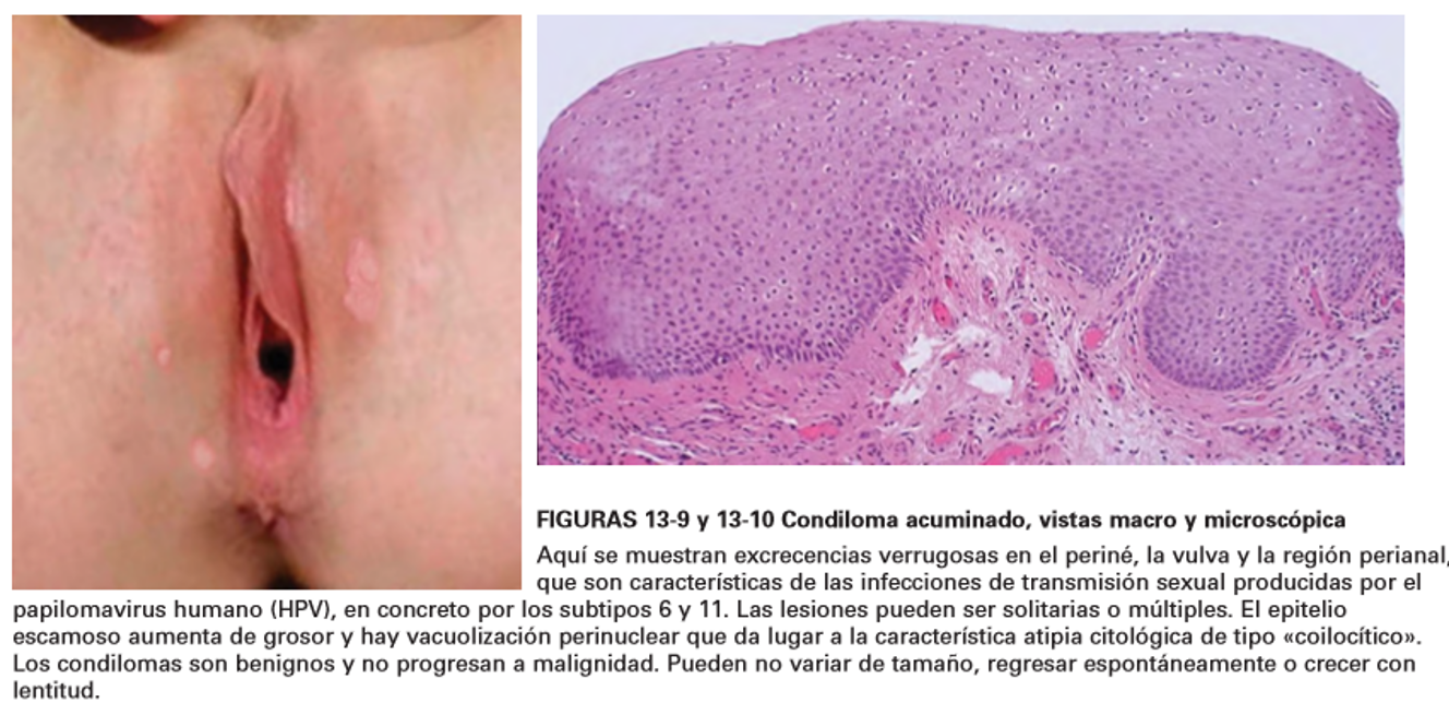 ENFERMEDAD INTRAEPITELIAL DE CERVIX, VAGINA Y VULVA
