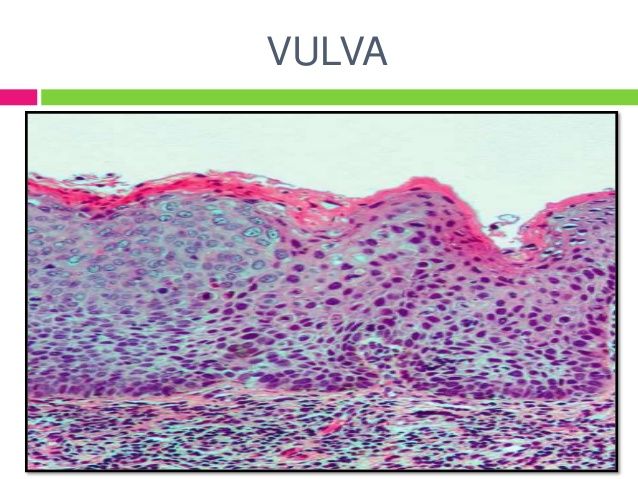 ENFERMEDAD INTRAEPITELIAL DE CERVIX, VAGINA Y VULVA