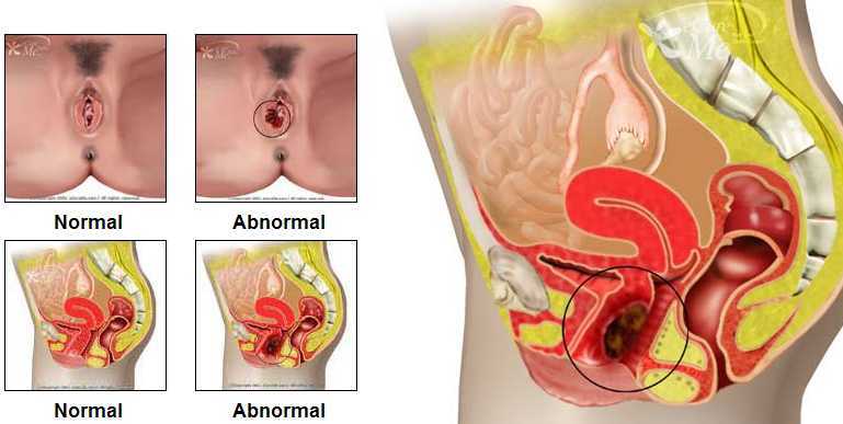 ENFERMEDAD INTRAEPITELIAL DE CERVIX, VAGINA Y VULVA