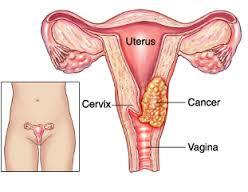 ENFERMEDAD INTRAEPITELIAL DE CERVIX, VAGINA Y VULVA