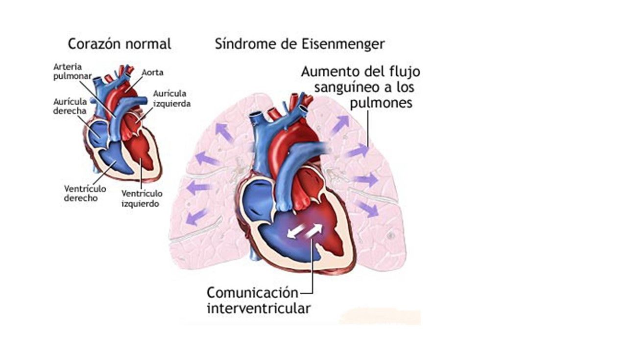Sesión 25: Enfermedad del corazón, pulmón y riñón durante el embarazo.