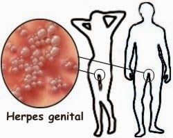 HERPES GENITAL