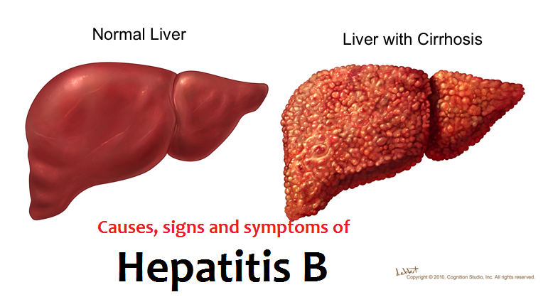 HEPATITIS B