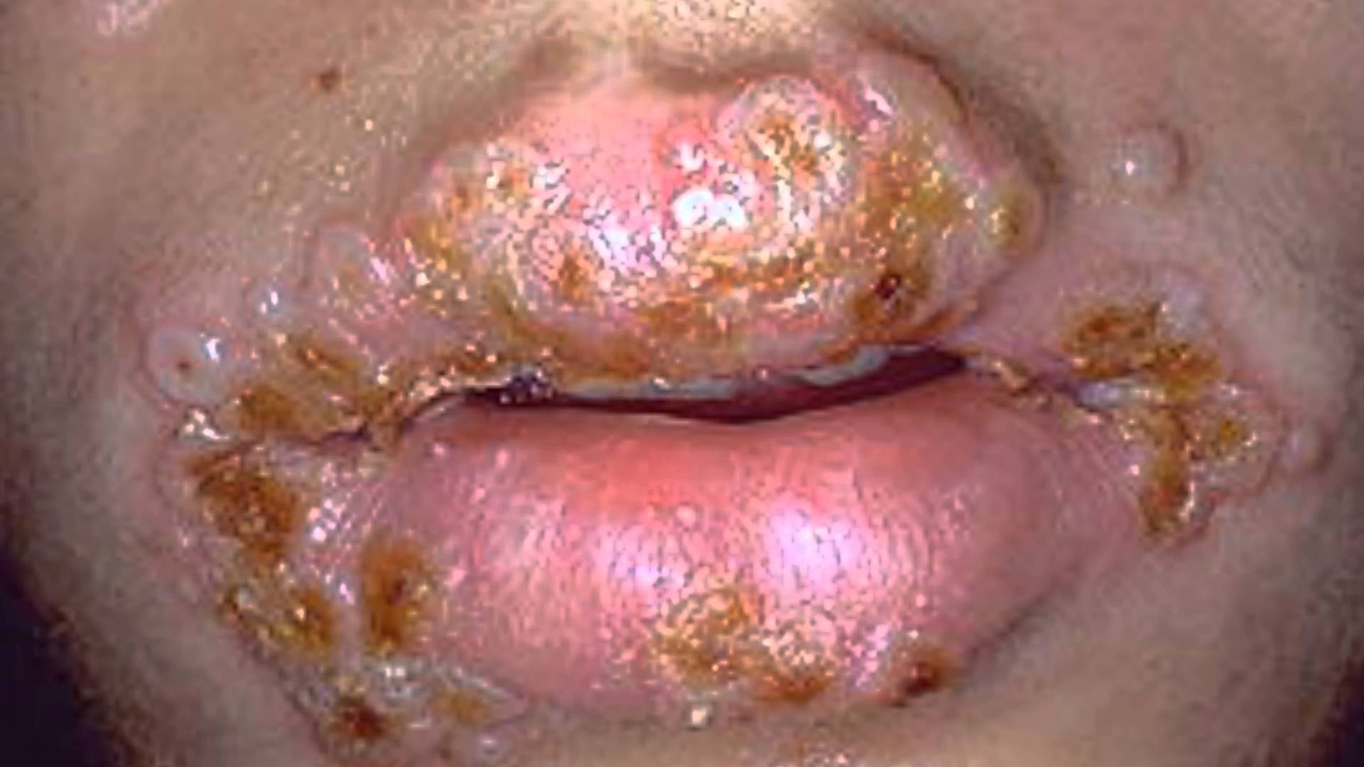 Infección bucofaríngea