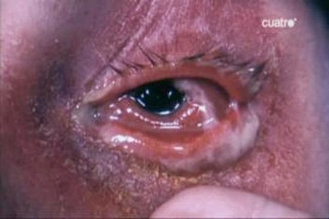 Infección en ojos