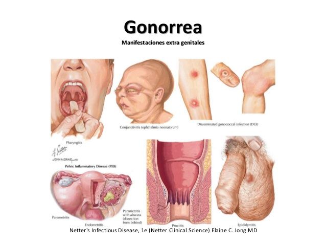 Gonorrea