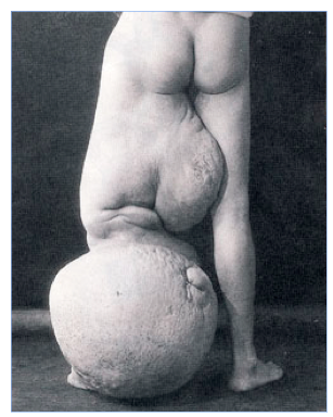 Elephantiasis.