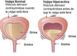 INCONTINENCIA URINARIA, PROLAPSO GENITAL Y TRANSTORNOS DEL PISO PELVICO